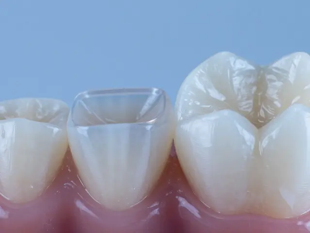 Celokeramické fazety versus korunky: Která varianta vydrží déle?