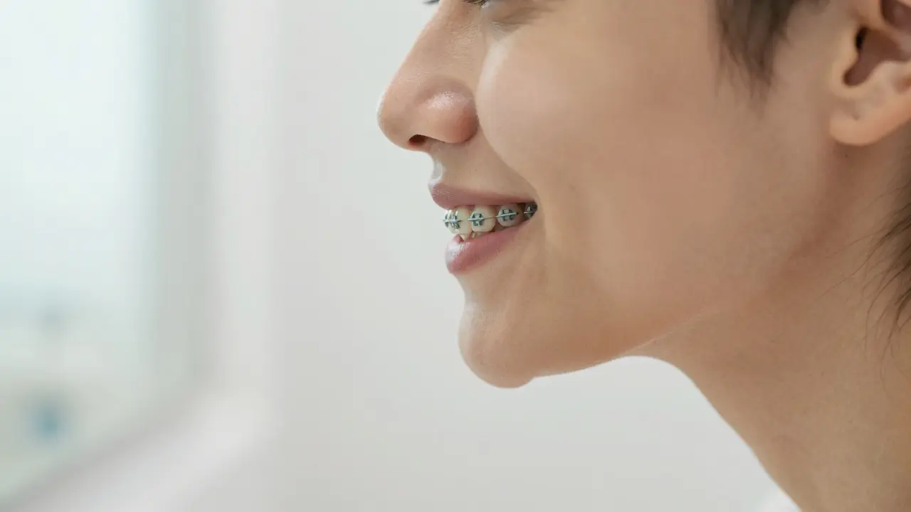 Jak fixní rovnátka změní váš vzhled a úsměv